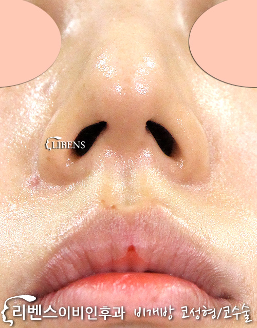 넓은 콧대 코뼈 콧등 성형 수술 모으기 매부리코 메부리코 절골 성형 s672